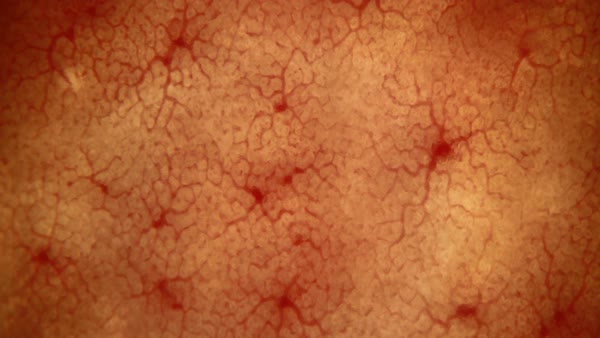 Bleeding from stomach ulcer, microscopy - Stock Video Footage - Dissolve