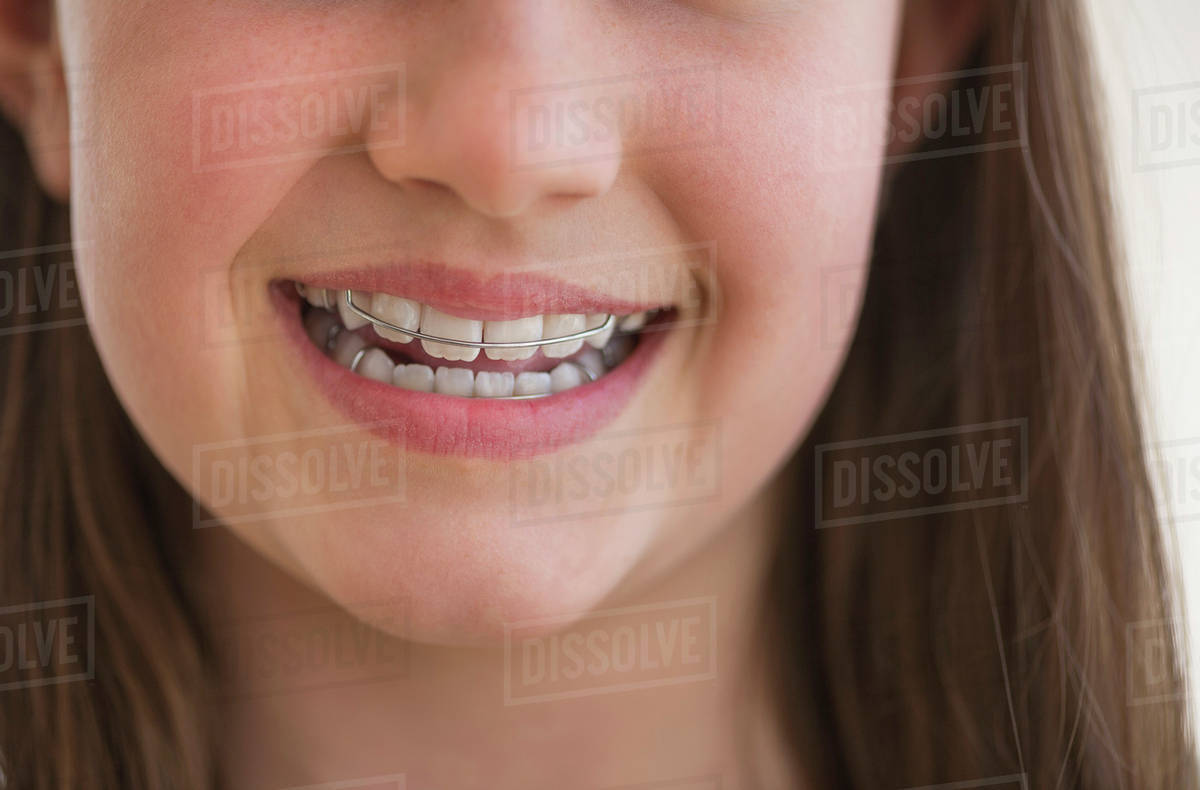 Girl (1011) wearing dental braces smiling Stock Photo Dissolve