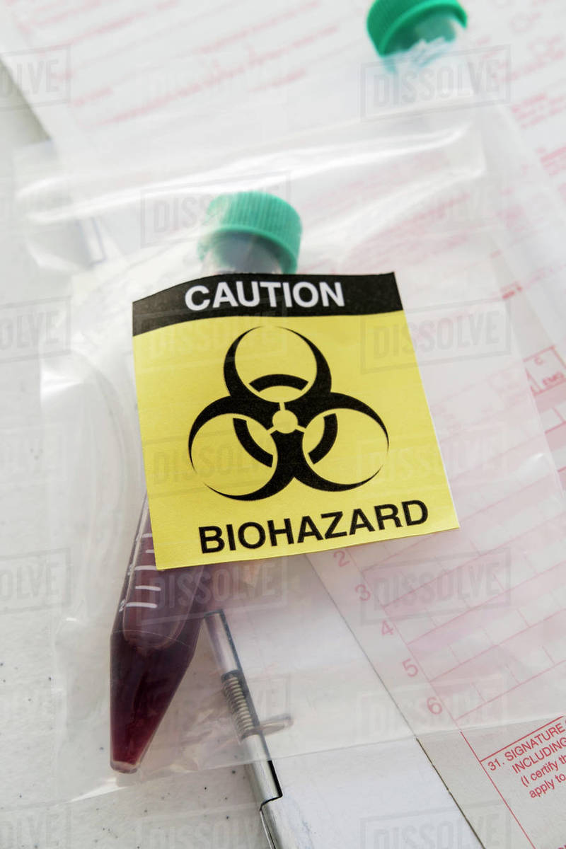 Blood sample with biohazard sign Stock Photo Dissolve