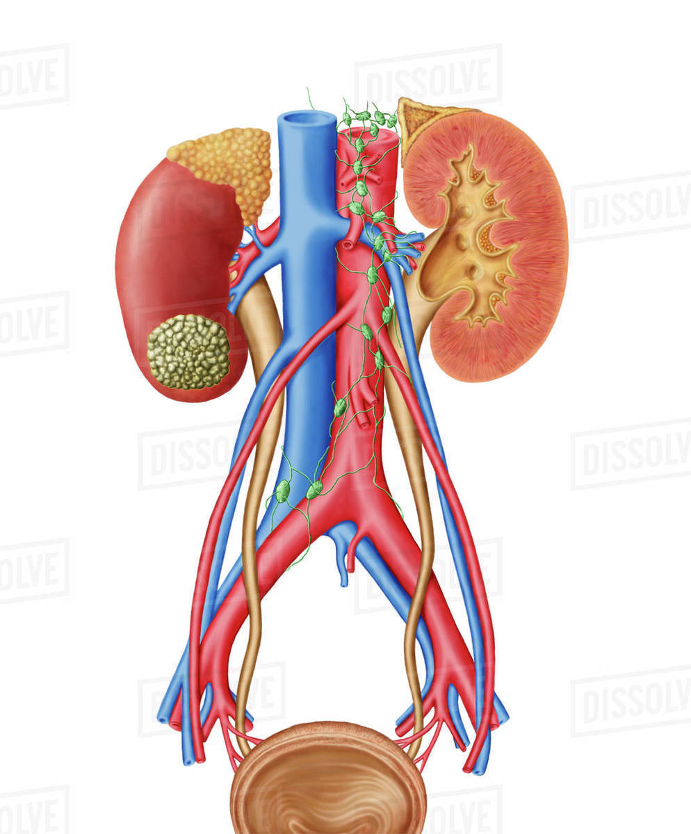 Early stage of kidney cancer with a tumor visible on the kidney. Stock Photo Dissolve