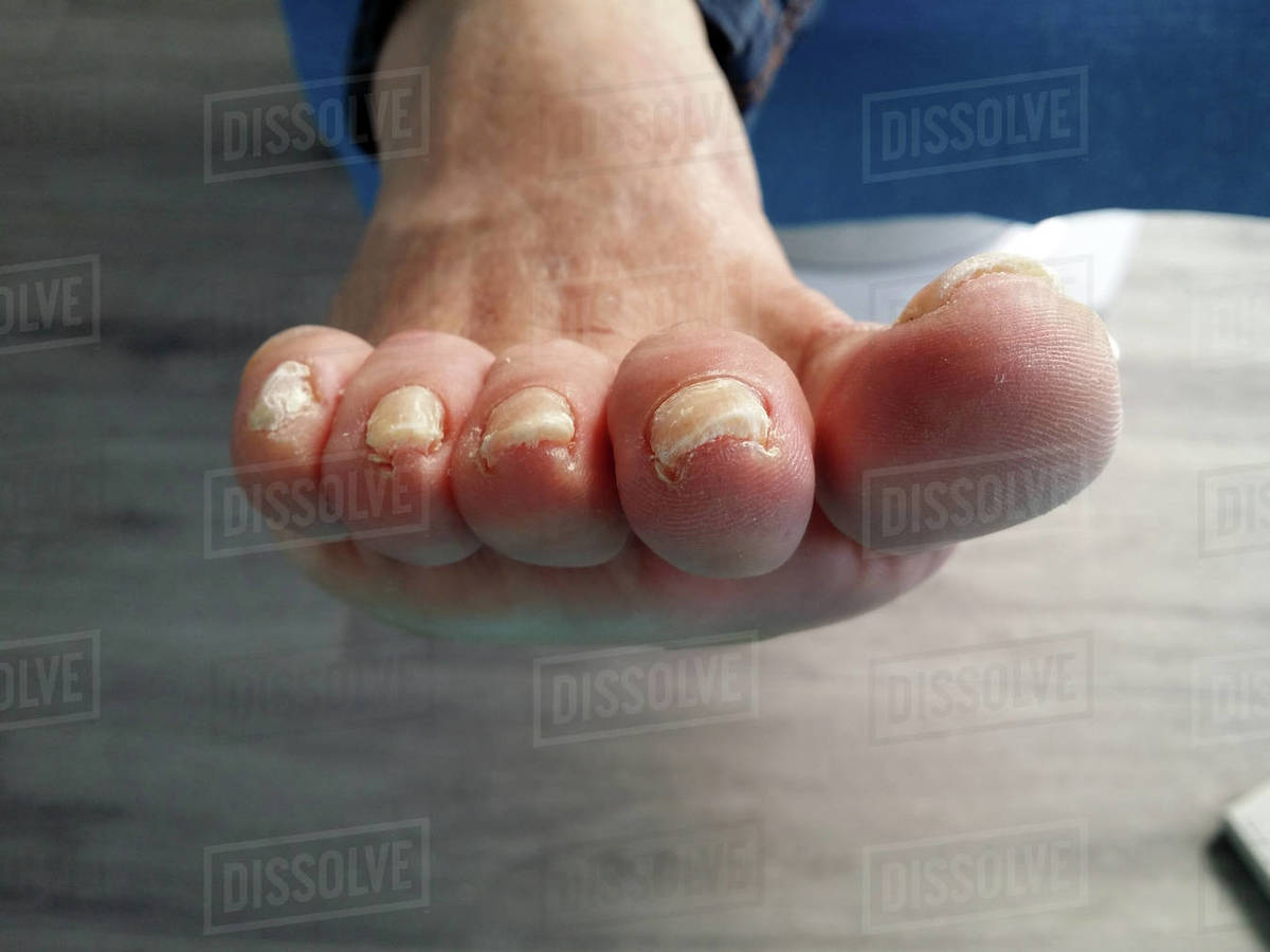 Inflamed big toe with ingrown toenail Stock Photo Dissolve